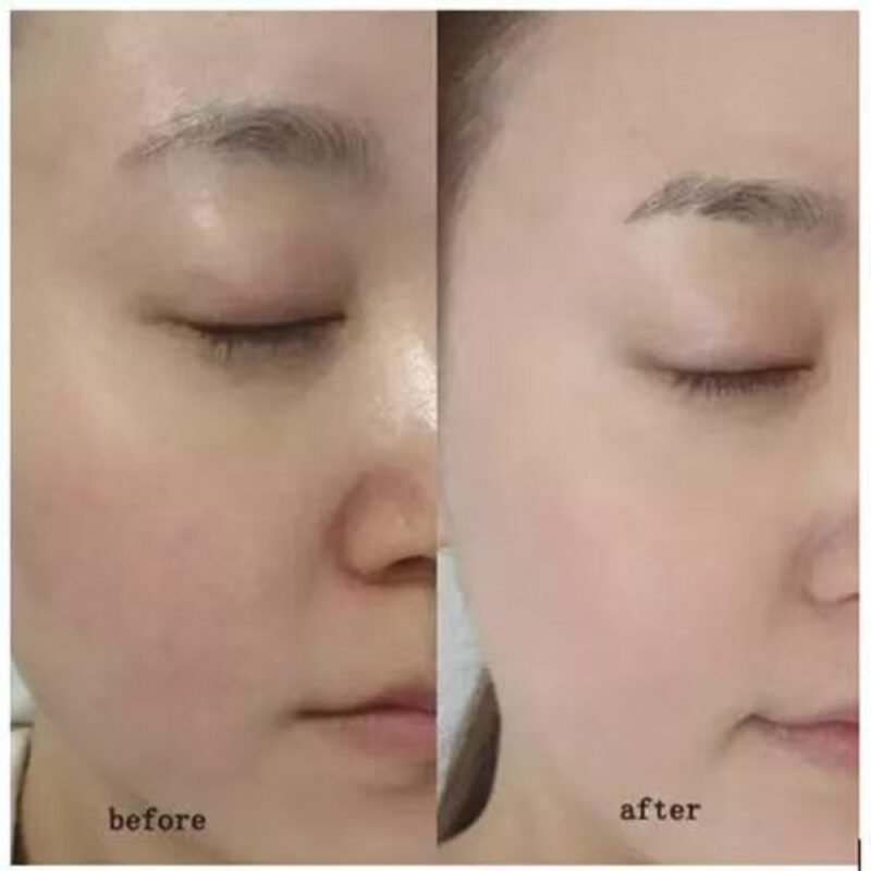 5ml Ordinary Mesotherapy Serum